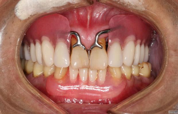 最新活动义齿技术引领牙齿修复新时代