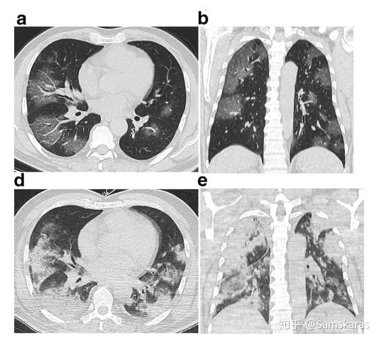 北京新冠肺炎最新症状观点阐述